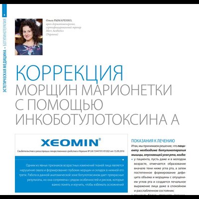 Коррекция морщин марионетки с помощью инкоботулотоксина А
