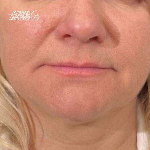 LOUNA Glossy Lips: активная гиалуроновая кислота - от объёма до биостимуляции_before_3