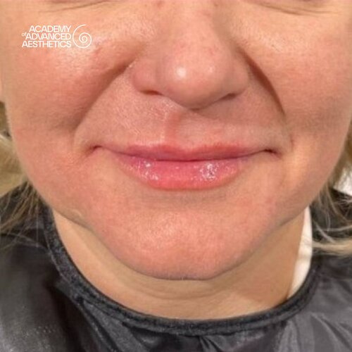 LOUNA Glossy Lips: активная гиалуроновая кислота - от объёма до биостимуляции_after_3