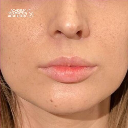 LOUNA Glossy Lips: активная гиалуроновая кислота - от объёма до биостимуляции_before_4