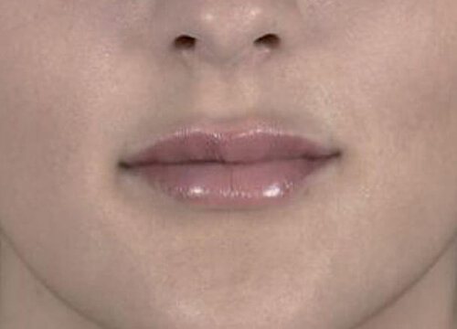 Belotero Intense_after_1