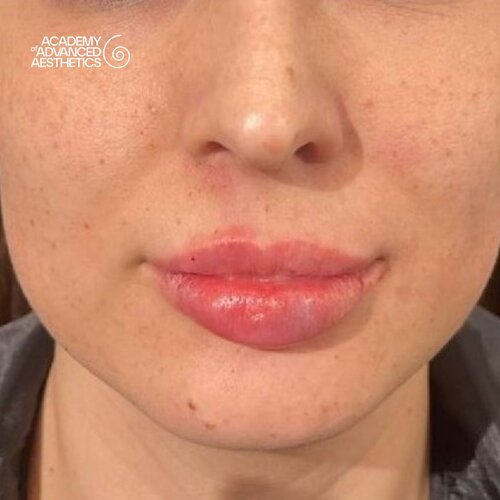 LOUNA Glossy Lips: активная гиалуроновая кислота - от объёма до биостимуляции_after_4