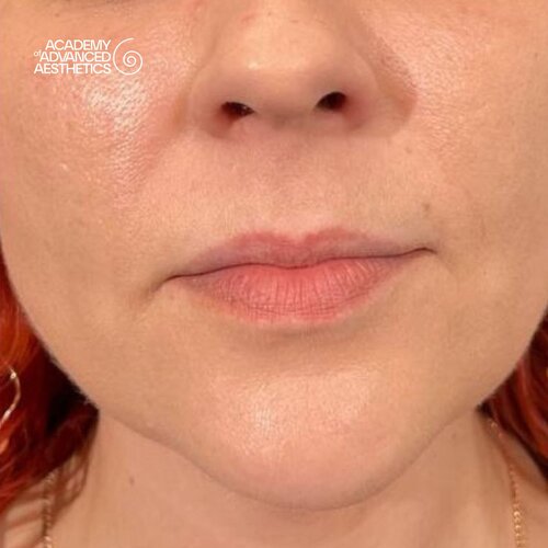 LOUNA Glossy Lips: активная гиалуроновая кислота - от объёма до биостимуляции_before_4