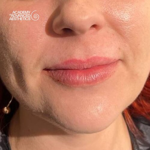 LOUNA Glossy Lips: активная гиалуроновая кислота - от объёма до биостимуляции_after_4