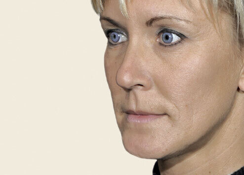 Belotero Volume_after_1