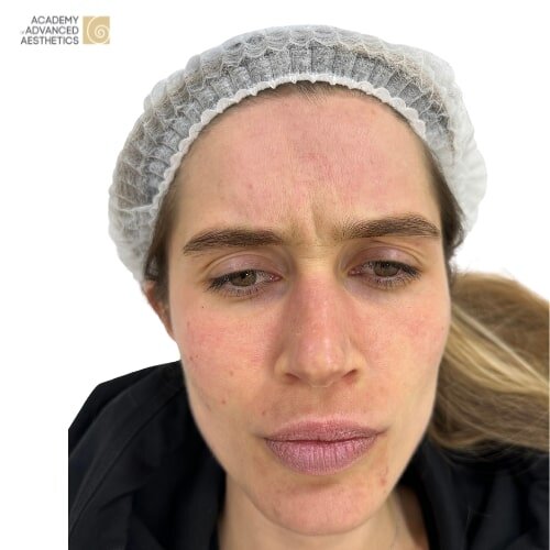 Botulinumtoxin_after_1