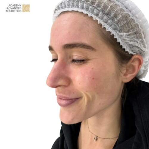 Botulinumtoxin_after_1