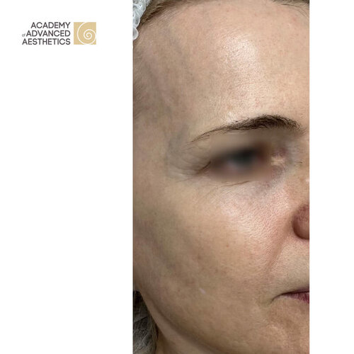 Juvelook & Lenisna_before_5