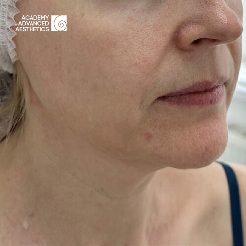 Juvelook & Lenisna_before_5