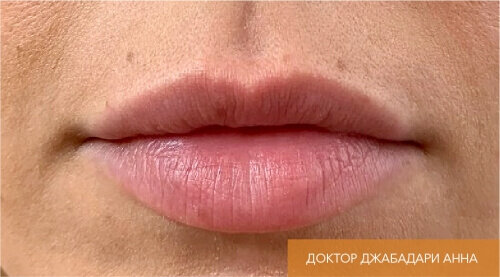 Искусство коррекции губ с филлерами Belotero_before_1