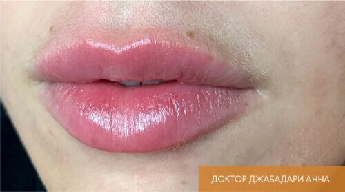 Искусство коррекции губ с филлерами Belotero_after_1