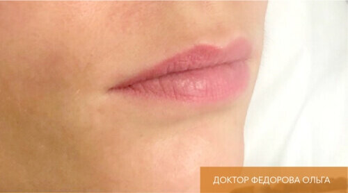 Искусство коррекции губ с филлерами Belotero_before_3