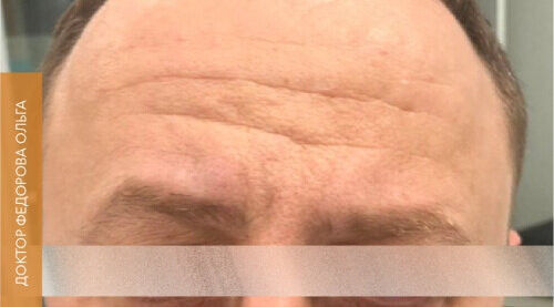 Искусство коррекции губ с филлерами Belotero_before_5