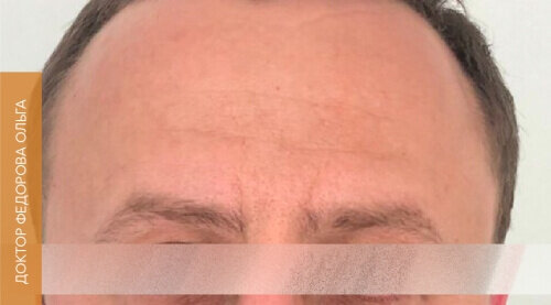 Искусство коррекции губ с филлерами Belotero_after_5