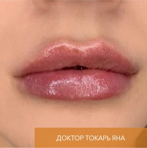 Искусство коррекции губ с филлерами Belotero_after_7