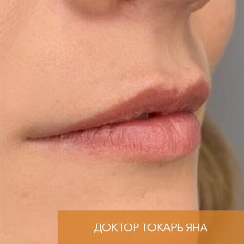 Искусство коррекции губ с филлерами Belotero_before_8