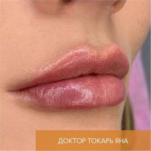 Искусство коррекции губ с филлерами Belotero_after_8
