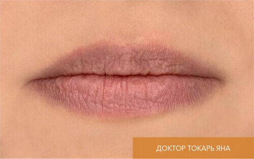 Искусство коррекции губ с филлерами Belotero_before_10
