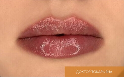 Искусство коррекции губ с филлерами Belotero_after_10
