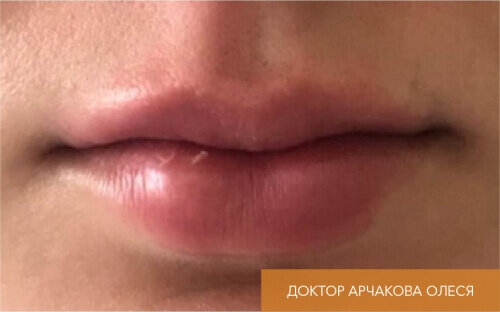 Искусство коррекции губ с филлерами Belotero_after_11