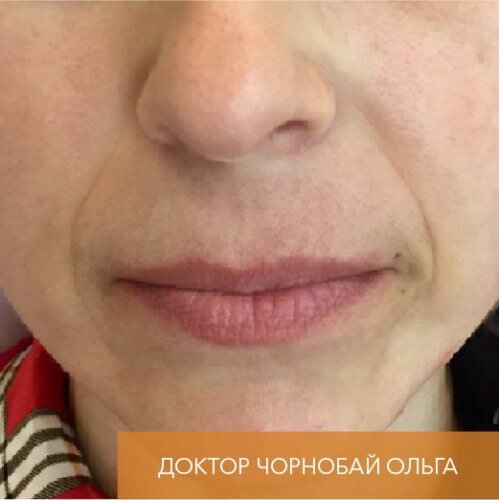 Искусство коррекции губ с филлерами Belotero_before_12