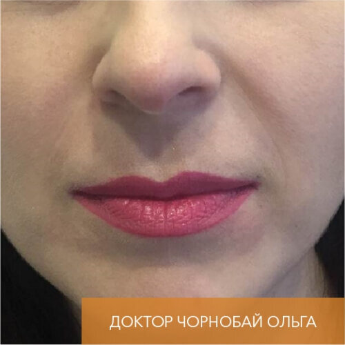 Искусство коррекции губ с филлерами Belotero_after_12