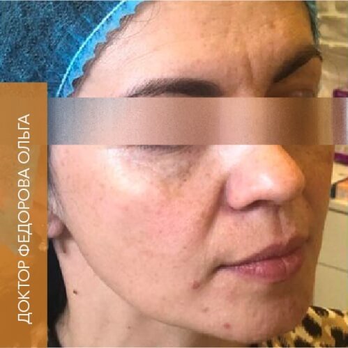 Искусство коррекции губ с филлерами Belotero_before_15