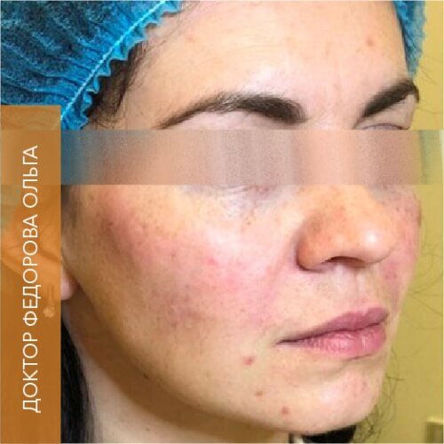 Искусство коррекции губ с филлерами Belotero_after_15