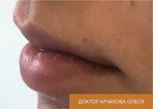 Искусство коррекции губ с филлерами Belotero_before_16