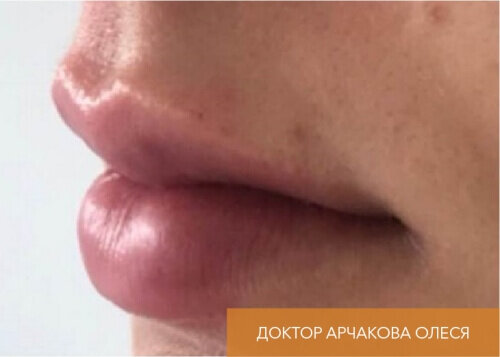 Искусство коррекции губ с филлерами Belotero_after_16