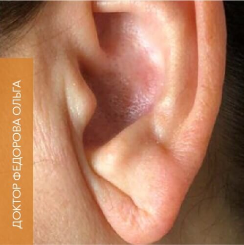 Искусство коррекции губ с филлерами Belotero_before_18