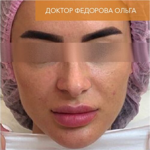 Искусство коррекции губ с филлерами Belotero_before_19