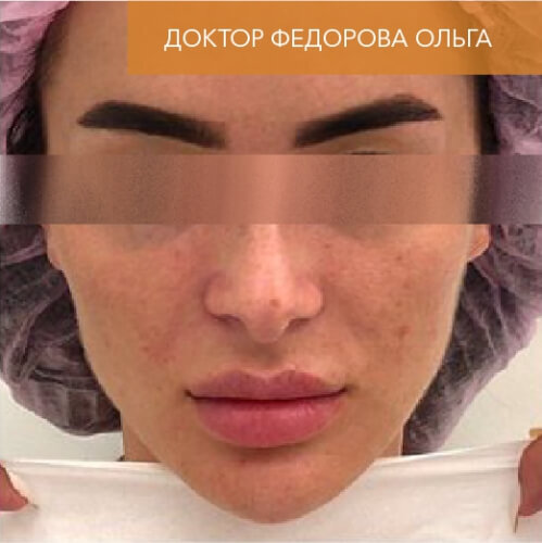 Искусство коррекции губ с филлерами Belotero_after_19