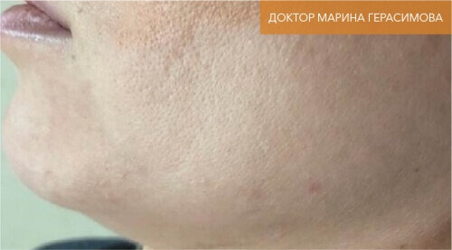 Искусство коррекции губ с филлерами Belotero_before_20