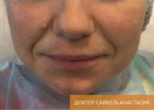 Искусство коррекции губ с филлерами Belotero_before_24