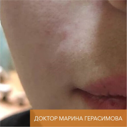 Искусство коррекции губ с филлерами Belotero_after_25