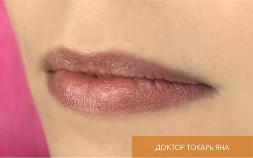 Искусство коррекции губ с филлерами Belotero_before_26