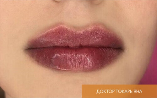 Искусство коррекции губ с филлерами Belotero_after_27