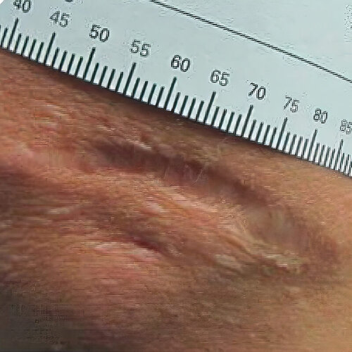 Лечение рубцов_before_1