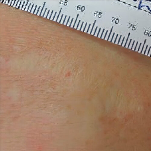 Лечение рубцов_after_1