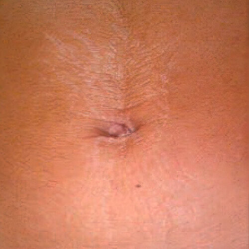 Лечение растяжек_before_1