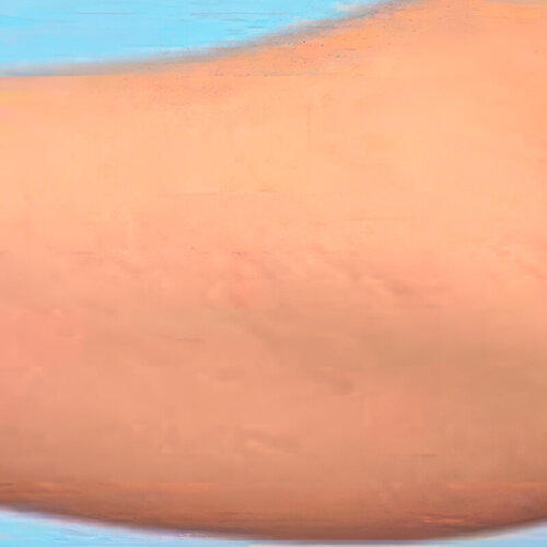 Лечение растяжек_after_2