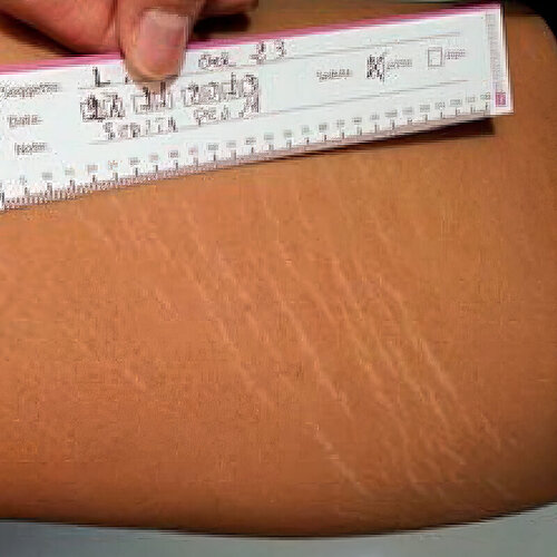 Лечение растяжек_before_2