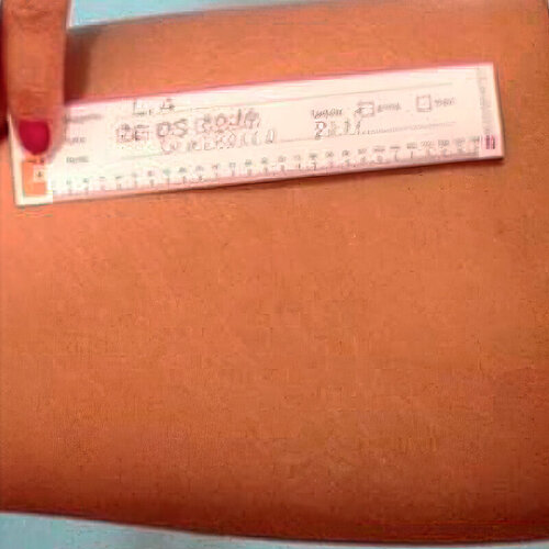 Лечение растяжек_after_2