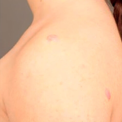 Лечение рубцов_after_2