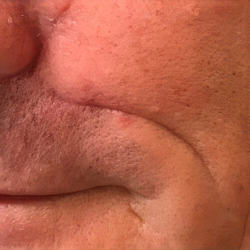 Лечение рубцов_before_3