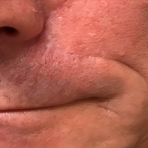 Лечение рубцов_after_3