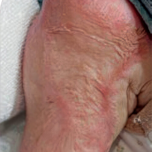 Лечение рубцов_before_3