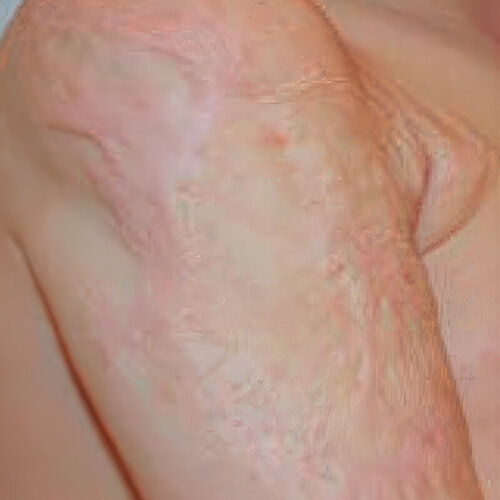 Лечение рубцов_after_3