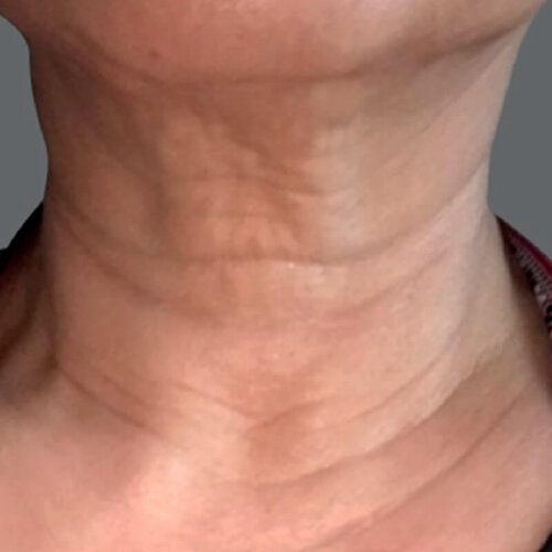 Double Tite_before_1